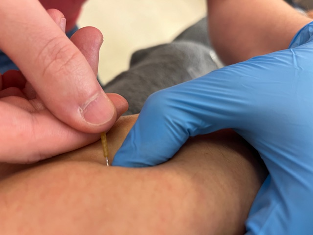 Dry needling am Arm